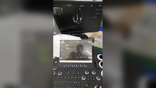 トロリーカラードップラー超音波診断装置 BR-US01